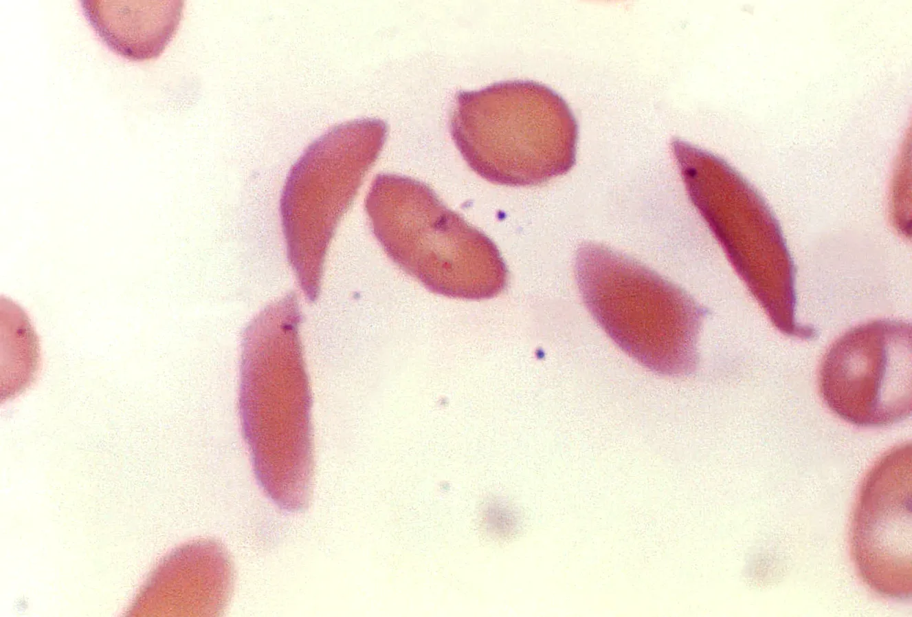 Connecticut participates in nationwide effort to expand Medicaid coverage for expensive sickle cell gene therapies