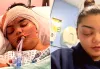 Teen Develops Life-Threatening Infection, Resulting in Eye Popping Out 'Like a Golf Ball' from Sniffles